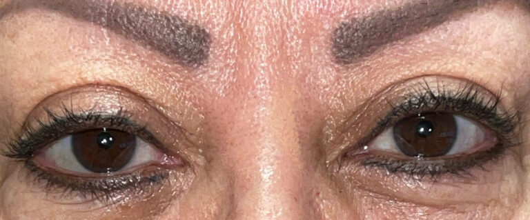After Image: Ptosis Repair - front