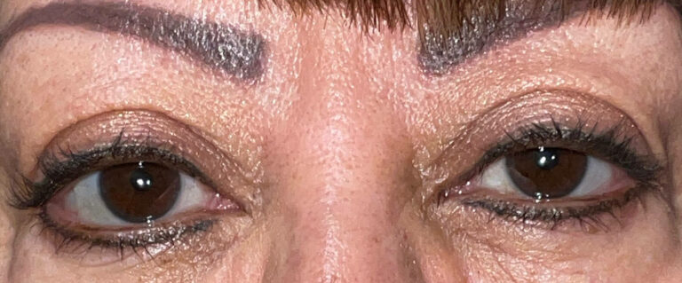 Before Image: Ptosis Repair - front