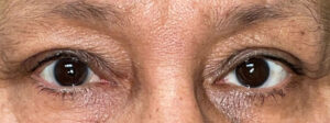 After Image: Ptosis Repair
