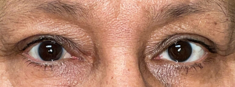 After Image: Ptosis Repair - front