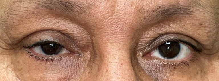 Before Image: Ptosis Repair - front