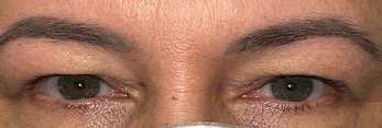 After Image: Ptosis Repair and Bilateral Upper Lid Blepharoplasty - 