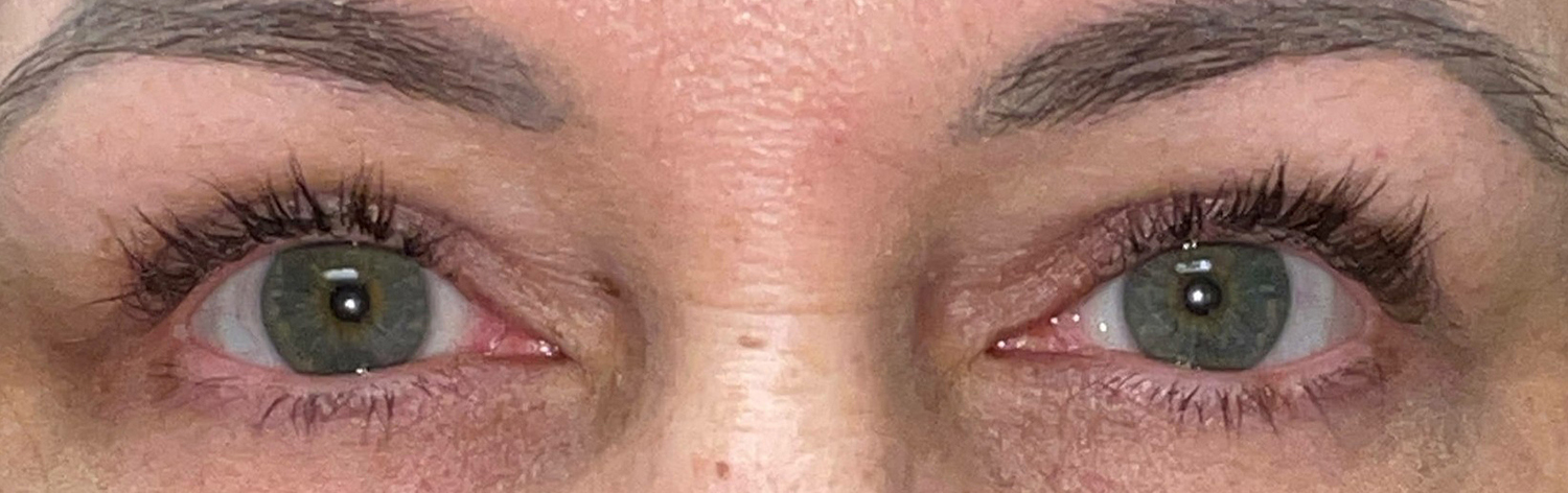Before and After Image: Ptosis Repair and Bilateral Upper Lid Blepharoplasty - front