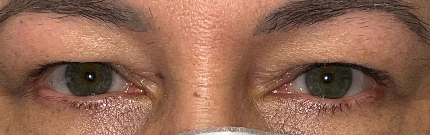 Before and After Image: Ptosis Repair and Bilateral Upper Lid Blepharoplasty - front