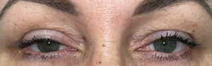 Before Image: Ptosis Repair and Bilateral Blepharoplasty