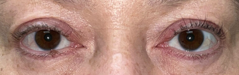 After Image: Ptosis Repair - front