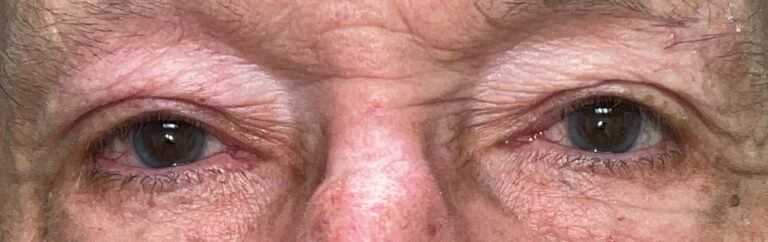 After Image: Ptosis Repair - front