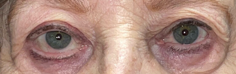 After Image: Ptosis Repair - front