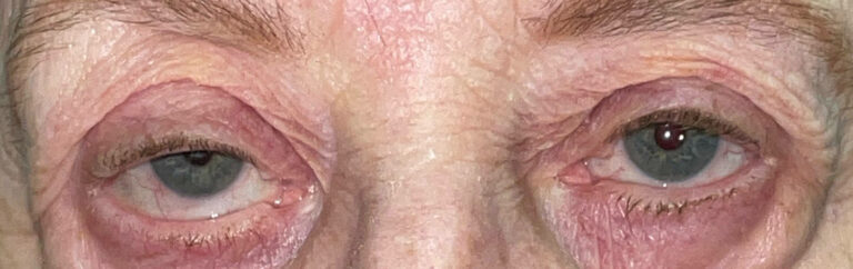 Before Image: Ptosis Repair - front