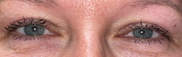 After Image: Bilateral Upper Lid Blepharoplasty - front