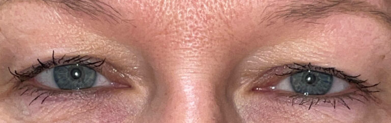 Before Image: Bilateral Upper Lid Blepharoplasty - front