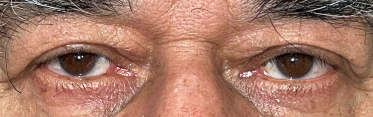 After Image: Ptosis Repair - front