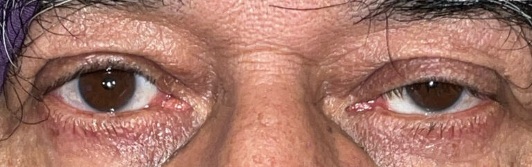 Before Image: Ptosis Repair - front