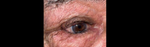 Before Image: Entropion Repair