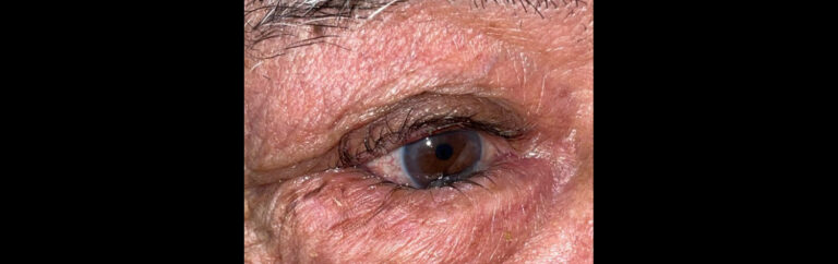 Before Image: Entropion Repair - right-front-oblique