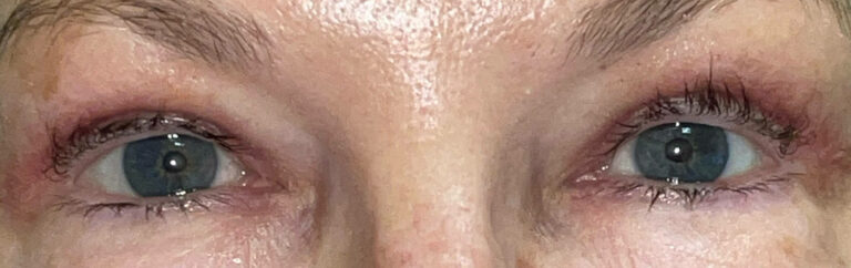 After Image: Bilateral Upper Lid Blepharoplasty - front