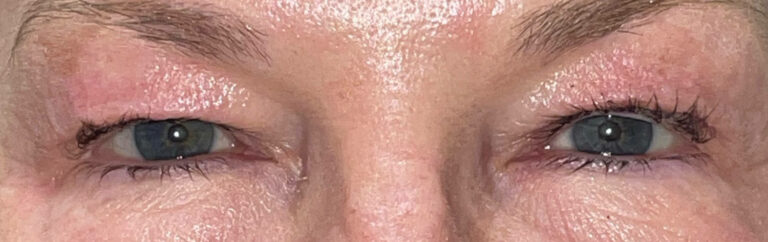 Before Image: Bilateral Upper Lid Blepharoplasty - front