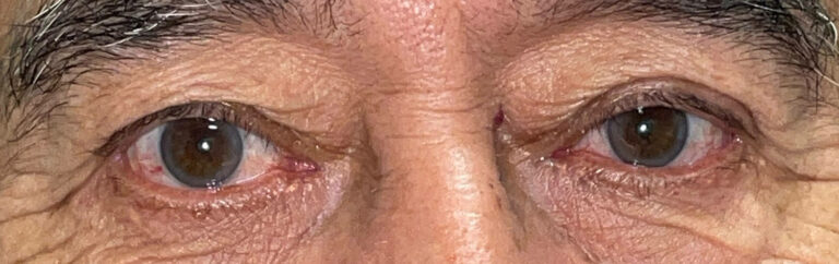 Before Image: Ptosis Repair and Bilateral Blepharoplasty - front