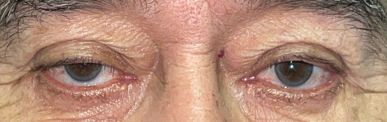 Before and After Image: Ptosis Repair and Bilateral Upper Lid Blepharoplasty - front