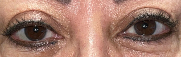 After Image: Ptosis Repair - front