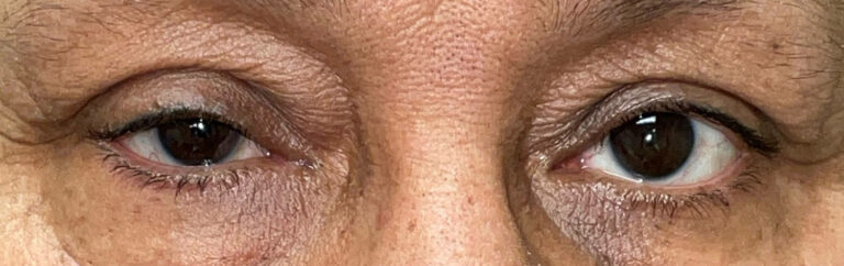 Before Image: Ptosis Repair - front