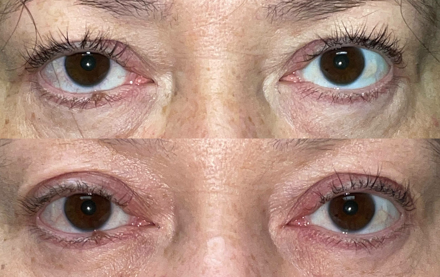 Before and After Image: Ptosis Repair - front