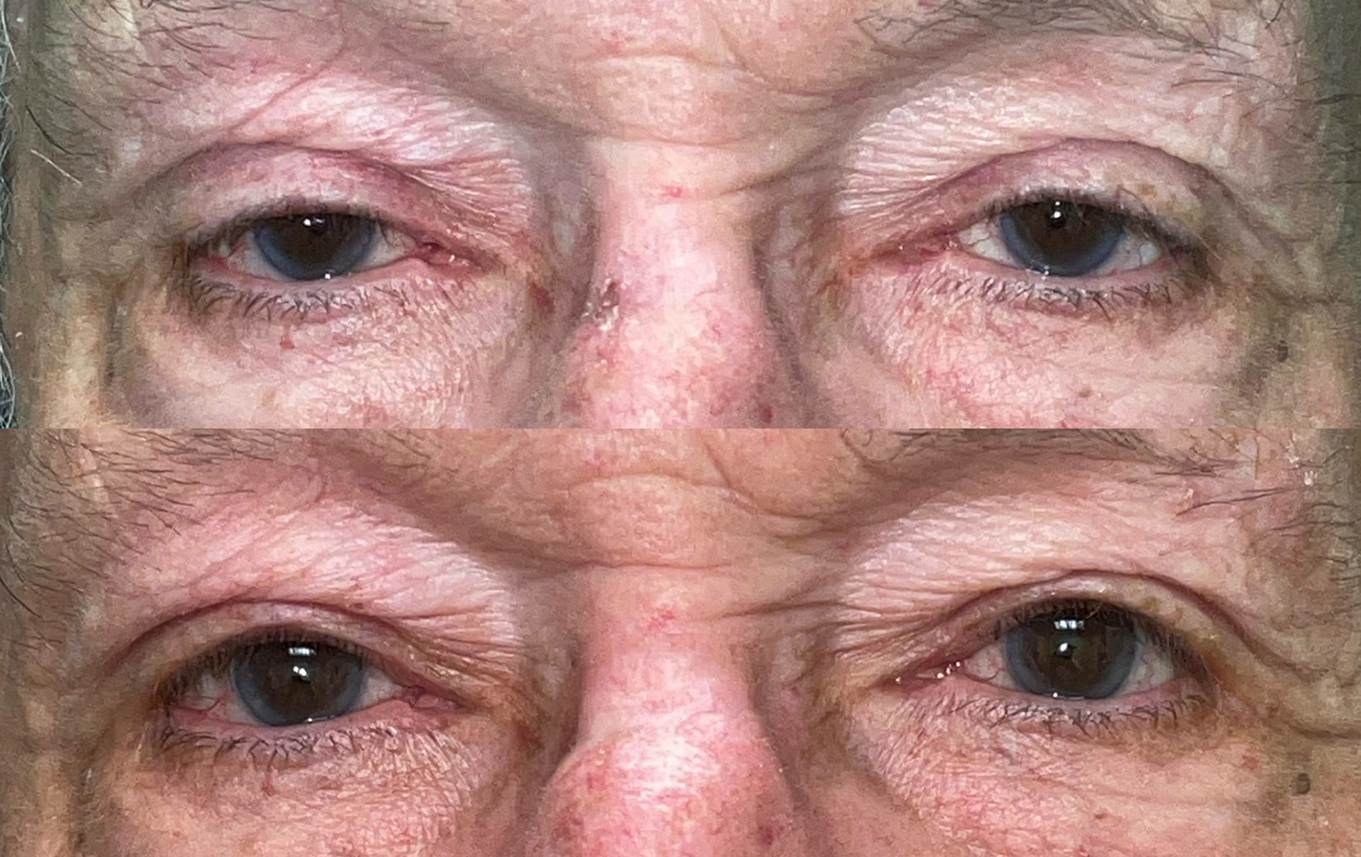 Before and After Image: Ptosis Repair - front