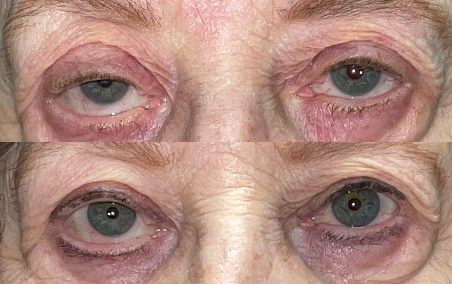 Before and After Image: Ptosis Repair - front