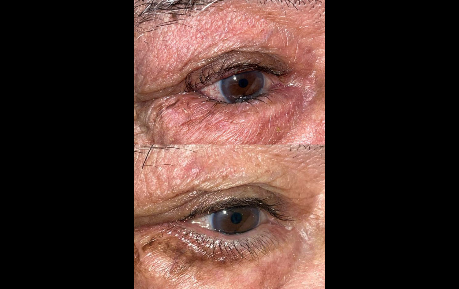 Before and After Image: Entropion Repair - right-front-oblique