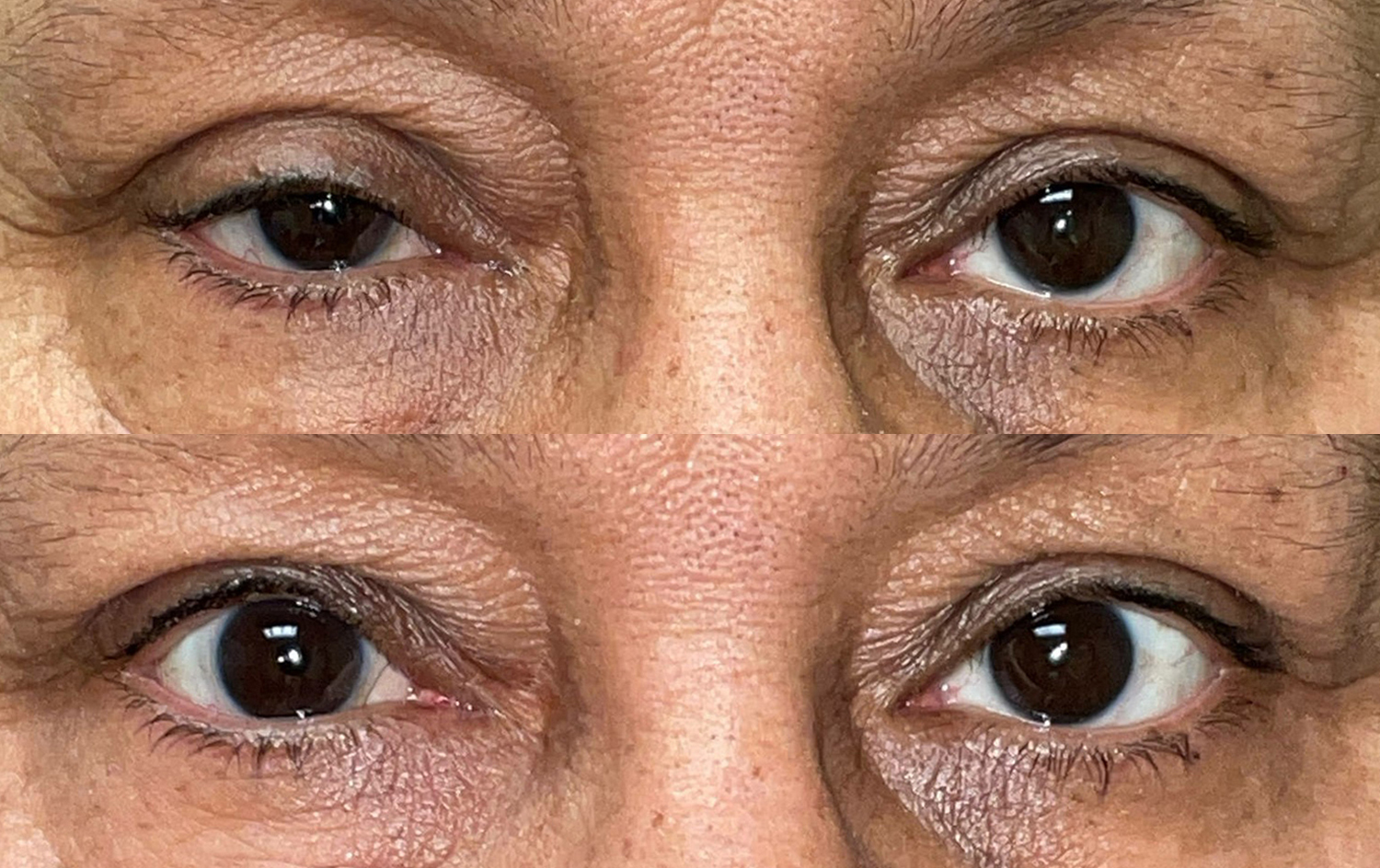 Before and After Image: Ptosis Repair - front
