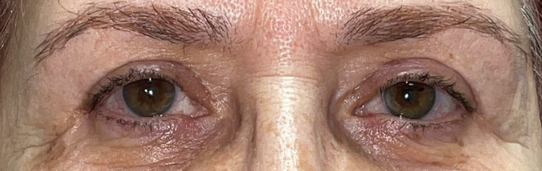 After Image: Bilateral Lower Lid Blepharoplasty - front