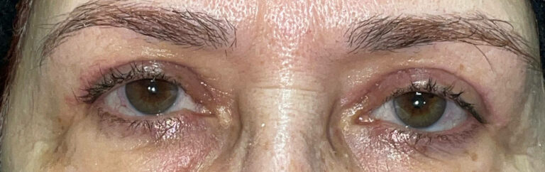 Before Image: Bilateral Lower Lid Blepharoplasty - front