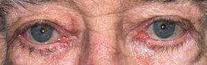 After Image: Ectropion Repair