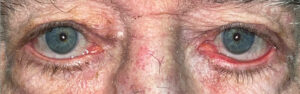 Before Image: Ectropion Repair