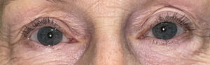 After Image: Ptosis Repair