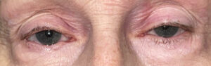 Before Image: Ptosis Repair