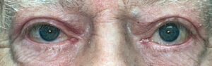 After Image: Ptosis Repair