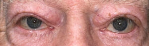 Before Image: Ptosis Repair