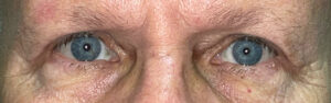 After Image: Bilateral Upper Lid Blepharoplasty