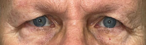 Before Image: Bilateral Upper Lid Blepharoplasty