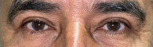 After Image: Bilateral Upper Lid Blepharoplasty