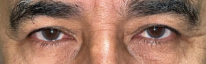Before Image: Bilateral Upper Lid Blepharoplasty