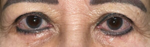 After Image: Ptosis Repair