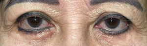 Before Image: Ptosis Repair