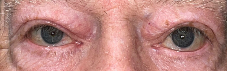 Before Image: Ptosis Repair - front