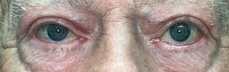 Before Image: Ptosis Repair - front