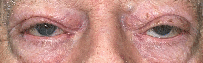 Before Image: Ptosis Repair - front