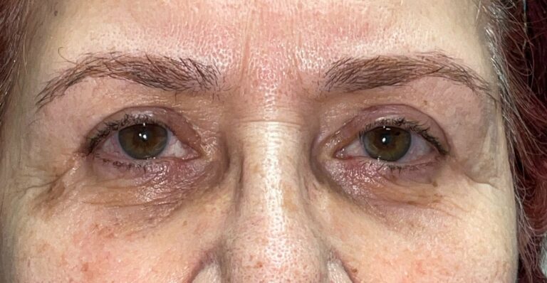 After Image: Bilateral Lower Lid Blepharoplasty - front