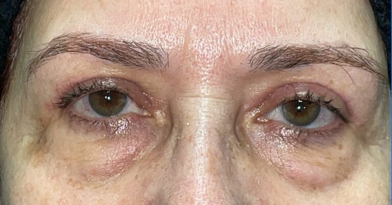 Before Image: Bilateral Lower Lid Blepharoplasty - front