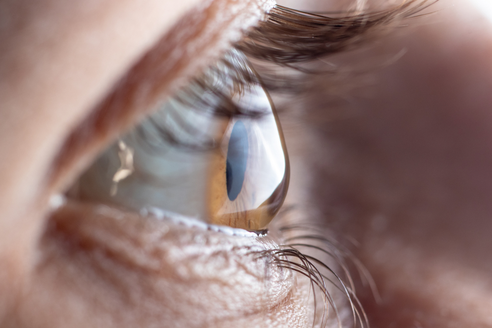 A close-up shot of an eye with an orbital tumor in Stockton, CA